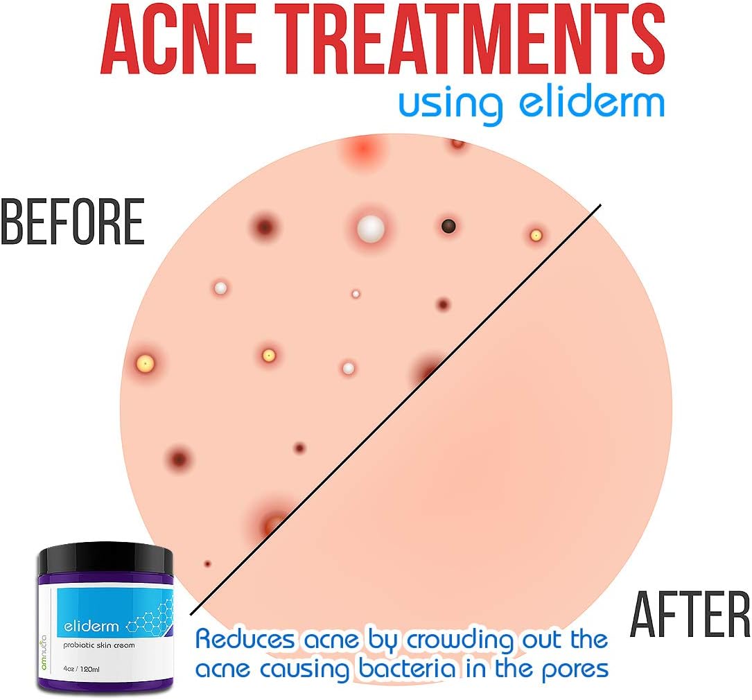 Topical Probiotic Skin Cream - 4OZ Jar 13 Strain Moisturizing Probiotic Lotion Eczema Treatment Psoriasis Treatment for Cystic Acne Probiotic Skin Care Cream Nail Fungus Treatment