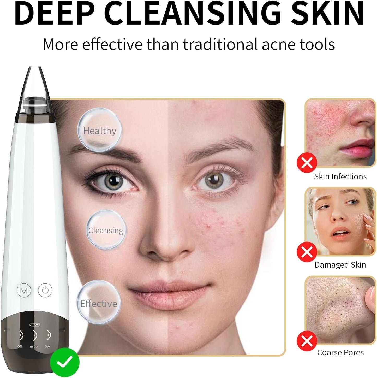 2025 Blackhead Remover Pore Vacuum,5 Suction Power,5 Probes,USB Rechargeable Blackhead Vacuum Kit-Facial Pore Cleaner Electric Acne Extractor Tool