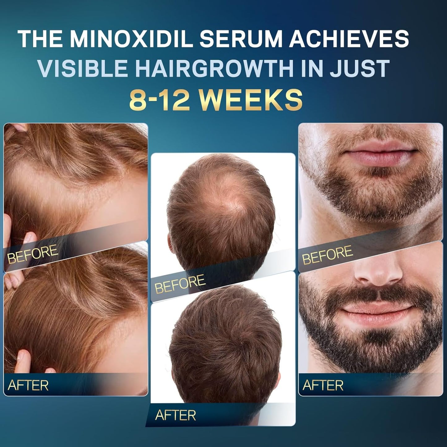 5% Minoxidil for Men and Women, Minoxidil Hair Growth Serum with Rosemary, Biotin - for Hair Regrowth, Beard Growth,Thicker, Fuller Hair,Hair Loss Treatment