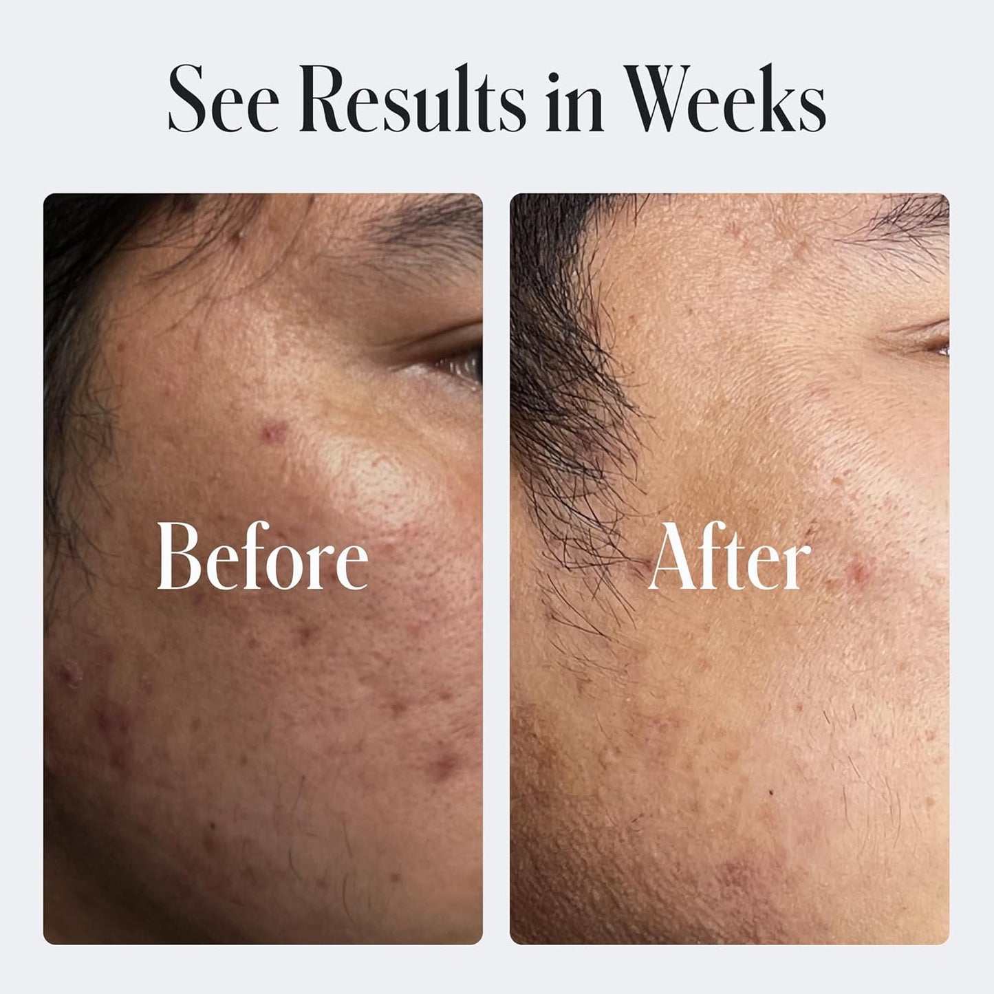 Geologie Clear Skin Face Cream | Clear System Daily Moisturizer with SPF15 for Acne-Prone Skin | Azelaic Acid, Niacinamide & Hyaluronic Acid | Lightweight & Oil Free | 60 ML