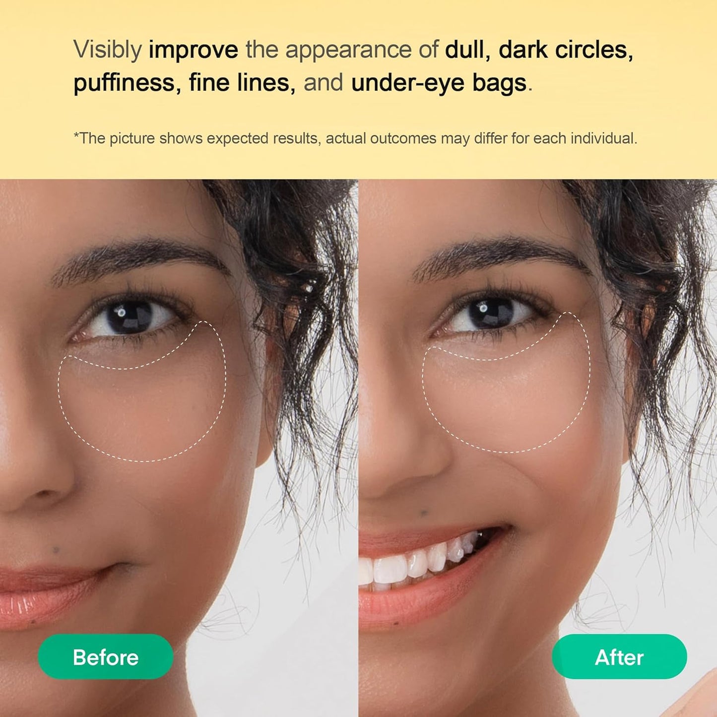 TEREZ & HONOR Vitamin C Eye Patches - 60 Pcs Korean Brightening & Hydrating Under Eye Masks with Tranexamic Acid, Caffeine, Hyaluronic Acid - Dark Circles, Puffiness & Wrinkles Hydrogel Treatment